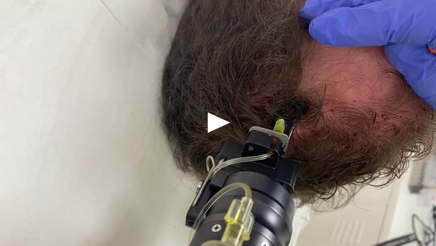 Mesotherapie Haar
