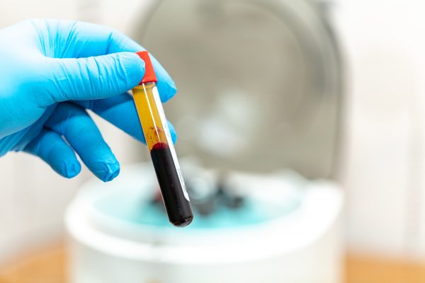 Eigenblut PRP-Verfahren_D-R-Beauty_Schönheitspraxis Eigenblut wird im PRP-Verfahren mit einer Mesopistole injiziert_D-R-Beauty_Schoenheitspraxis